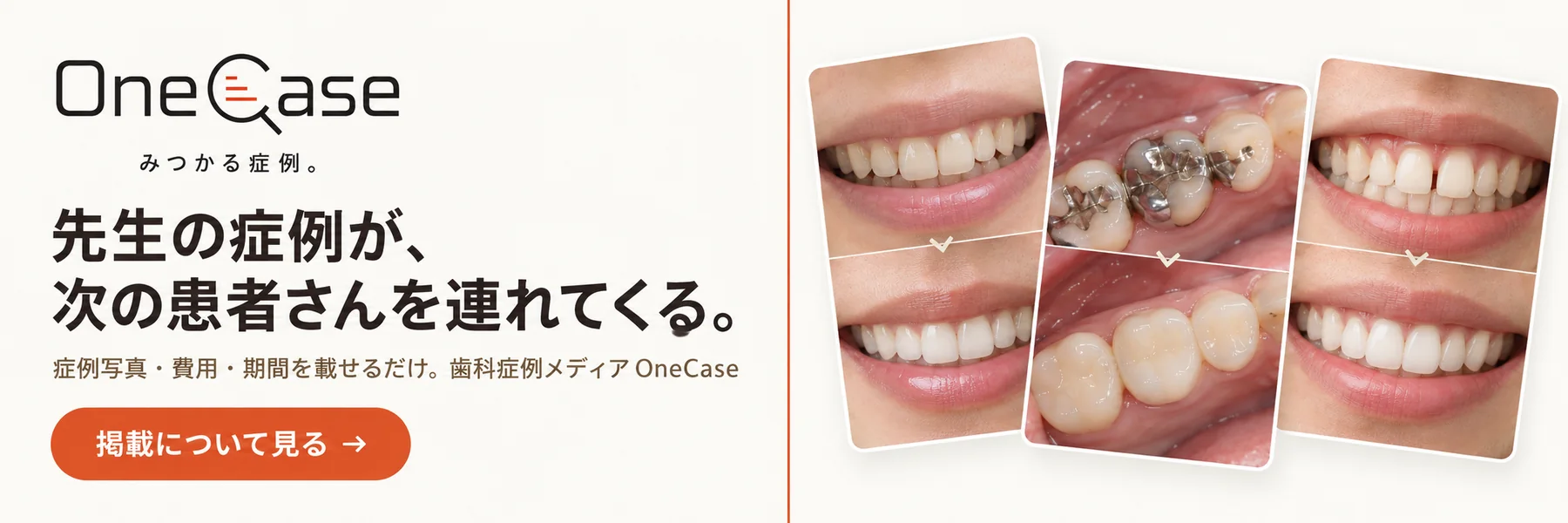 歯科症例メディア OneCase。先生の症例が、次の患者さんを連れてくる。症例写真・費用・期間を載せるだけ。掲載について見る